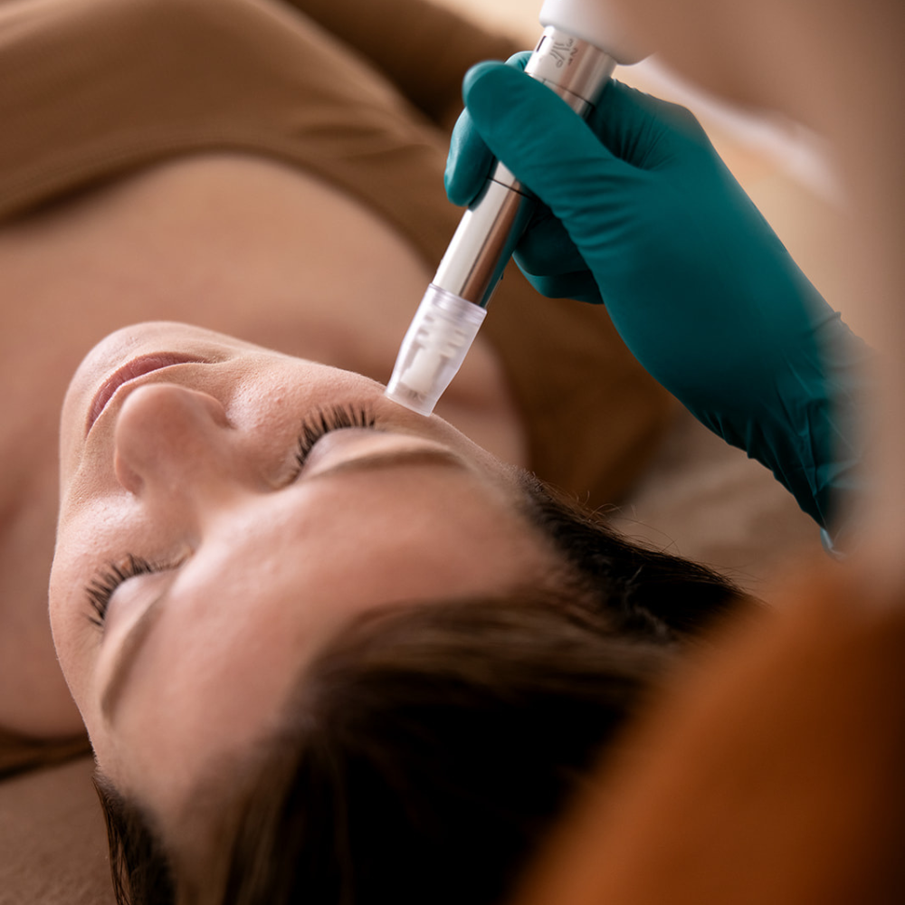 Microneedling